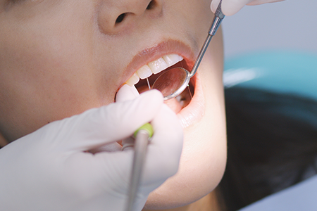 ３．歯周病の治療